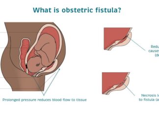 Untold tales of heroines battling fistula; pregnant women’s dreaded nightmare An illustration of how obstetric fistula occurs. Worryingly, a whopping 2 to 3 million women worldwide have fistula, according to data by UNFPA. ILLUSTRATION/Catherine Hamlin Fistula Foundation.